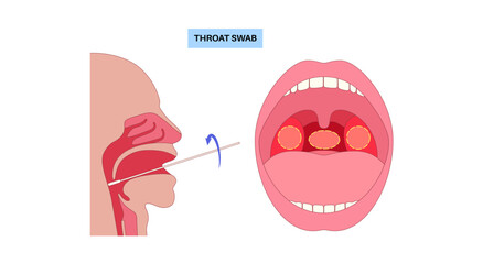Swab throat procedure