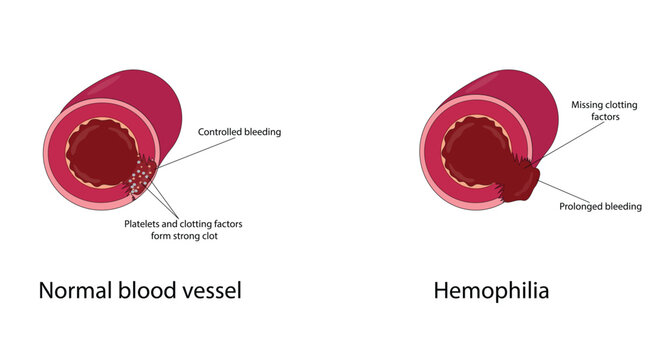 Hemophilia vector illustration
