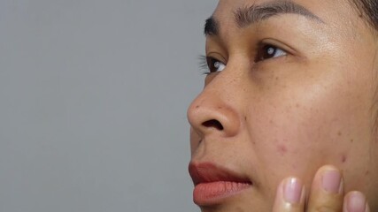 An Asian woman pointing at acne and blemishes on her cheek, showing skin problems and facial imperfections.