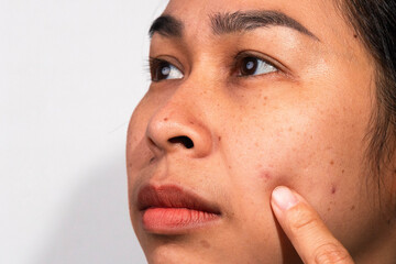 An Asian woman pointing at acne and blemishes on her cheek, showing skin problems and facial...