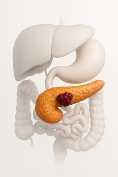3D render of abdominal region with pancreas in natural position behind stomach near duodenum. Dark-red irregular tumor mass visible in pancreatic head, other organs softly faded for medical realism