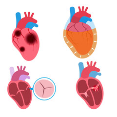 Medical illustration set on cardiology and healthcare. Includes diagrams of heart disease, atherosclerosis, dialysis, plus 3D stethoscopes and blood pressure icons. Isolated vector graphics.
