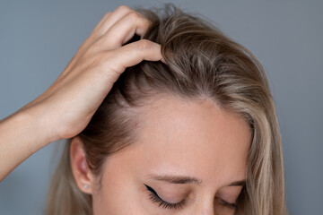 Close-up of a young woman's scalp with visible thinning hair and receding hairline. Healthy scalp...