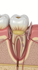 3D Medical Illustration of Gum Pocket Formation from Severe Periodontitis