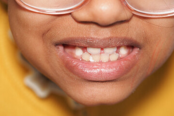 Young child smiles broadly showing missing teeth