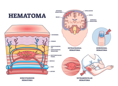 Hematoma_Diagram_outline shows types of hematomas with labeled sections of skin, brain, and finger, highlighting blood accumulation, transparent background.