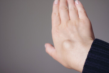 Female right back hand with ganglion cyst on the dorsum,  fluid-filled bump associated with a joint or tendon sheath, close-up view, selected focus.