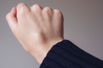 Female right back hand with ganglion cyst on the dorsum,  fluid-filled bump associated with a joint or tendon sheath, close-up view, selected focus.