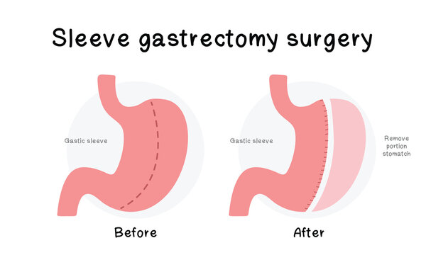 Illustration sleeve gastrectomy surgery