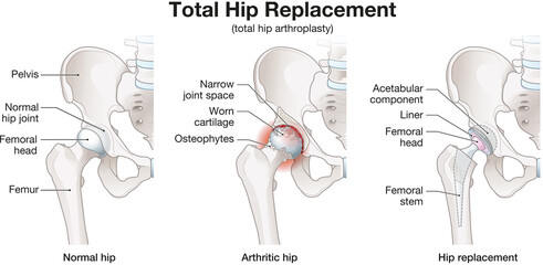 Total Hip Replacement &ndash; Medical Illustration of Hip Prosthesis