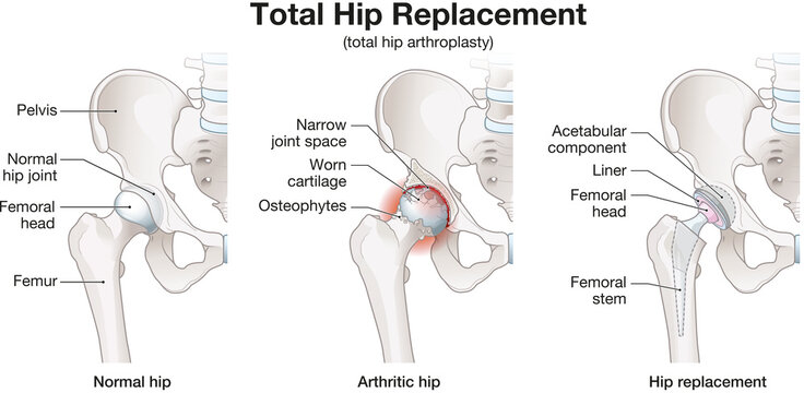 Total Hip Replacement &ndash; Medical Illustration of Hip Prosthesis