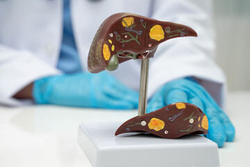 Cirrhosis, Liver cancer, fatty liver, Asian doctor with liver human anatomy model in World...