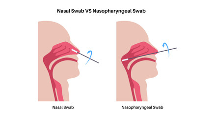 Nasopharyngeal and nasal swab