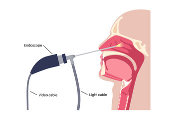 Nasal endoscopy poster