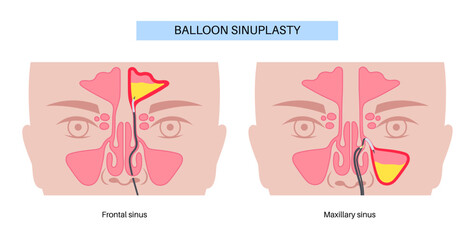 Obraz premium Balloon sinuplasty poster