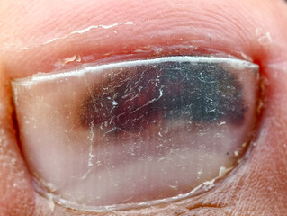 Fototapeta premium Close-up of a human foot with a bruise under the big toenail