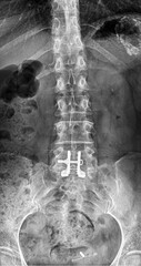 Diagnostic medicine, x-ray image of the spinal column. An interspinous spacer is implanted between the spinous processes of the vertebrae L5-S1