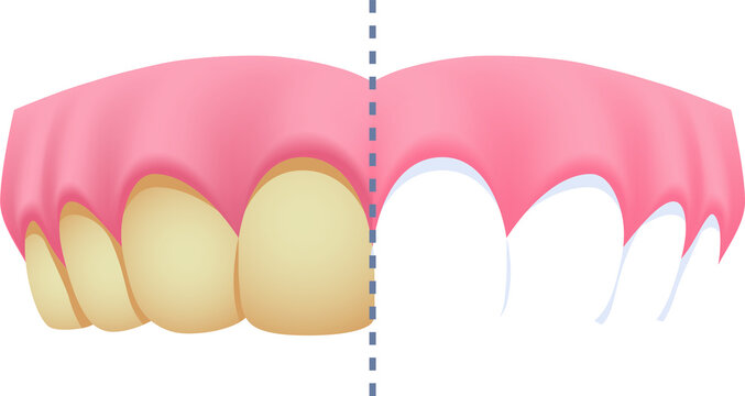 Upper teeth - Brown (Before and After Comparison) illustration transparent design. Dental care concept.