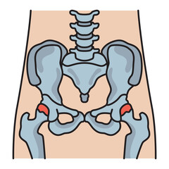 Hip Pain
