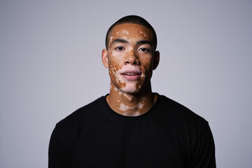 Fototapeta premium Portrait of a young man with vitiligo skin condition