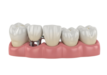 A 3D medical illustration of dental implants strategically positioned within the upper jaw.