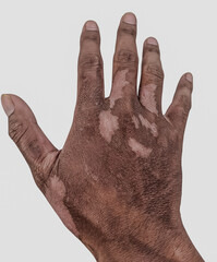 Human hand with vitiligo skin condition isolated on white background, showing depigmentation...