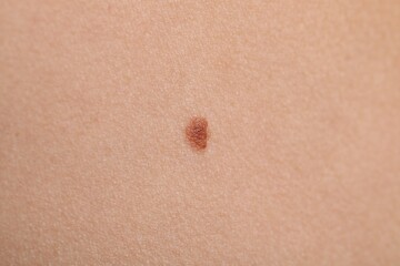 Woman with mole on her body, closeup