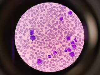 Human blood pathology with myelocytes under microscope