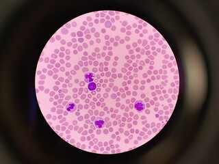 Human blood smear showing blast cell under microscope
