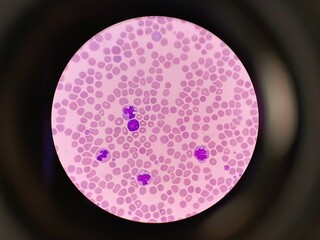 Human blood smear showing blast cell under microscope