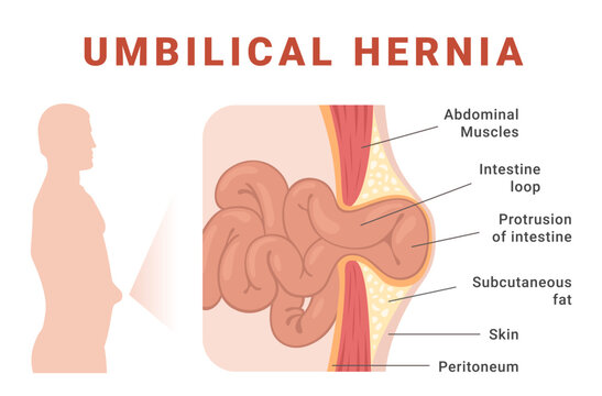 Infographics related to understanding the anatomy of an umbilical hernia and its impact on human abdominal health