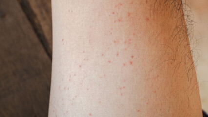 A close-up view of a leg showing small red spots on the skin, indicating a potential skin condition or reaction. The image captures the area in natural daylight