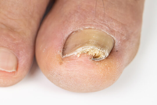 Ingrown toenail on a senior feet with white background
Close-up ingrown toenail on senior feet with white background.