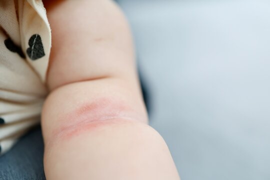 汗疹で赤くなった赤ちゃんの腕のアップと肌トラブル