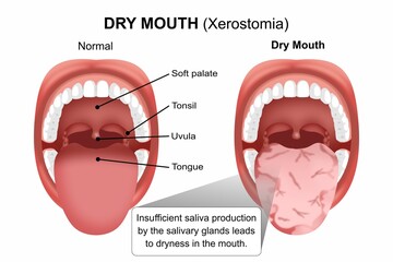 Dry Mouth - Xerostomia Medical Flashcard Illustration