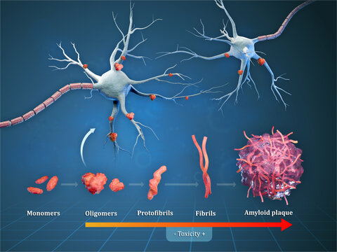 Amyloid plaques formation in Alzheimer disease