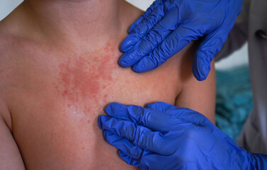 The doctor observes the boy for symptoms of chickenpox.