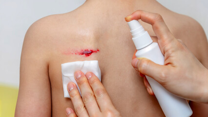 Child receiving care for a minor wound in a bright and clean indoor location, with an adult applying antiseptic spray