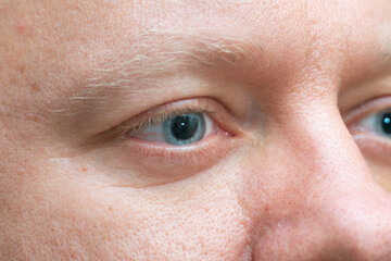 Fototapeta premium Close-up of a man eyes with dilated pupils. Pupil dilation after ophthalmologist performed a pupil dilation to examine the retina