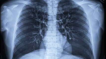 Lung Cancer XRay Scan. - Powered by Adobe