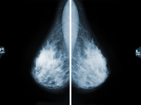 X-ray digital mammography image mlo view for screening breast cancer.
