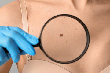 Dermatologist with magnifier examining mole on woman's chest against light background, closeup