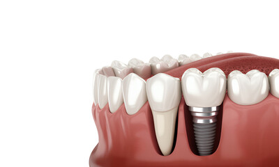 Dental implant and healthy teeth, anatomical model of dental work.