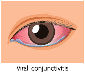 Red Eye with Viral Conjunctivitis Symptoms Illustration
