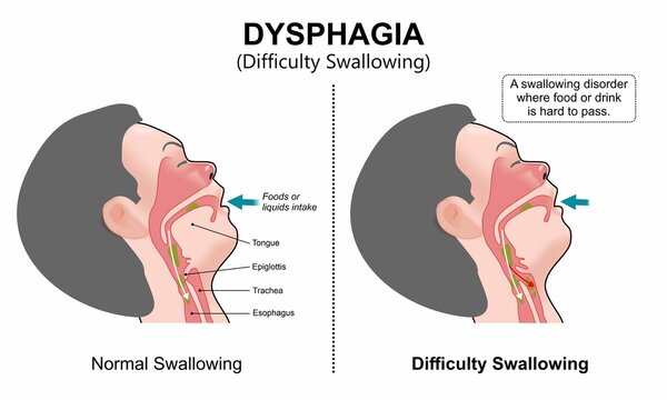 Dysphagia difficulty swallowing medical flashcard illustration