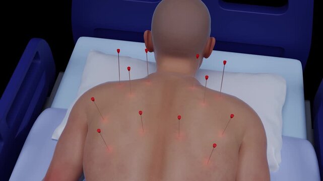 3D Animation of Dry Needling Therapy on Upper Back for Pain Relief. Animated Medical Illustration of Acupuncture. Dry Needling Physiotherapy Animation. 3D Illustration of Trigger Point Therapy