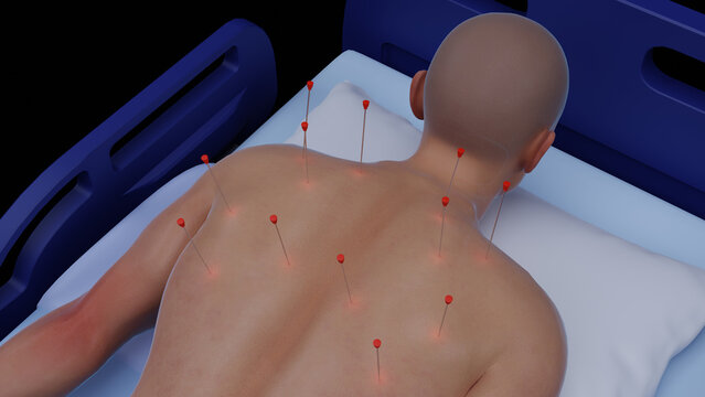 3D Illustration of Dry Needling Physiotherapy. Dry Needling Therapy on Upper Back for Pain Relief. Medical Treatment Using Dry Needling 3D Render. Dry Needling Therapy for Muscle Tension. Acupuncture