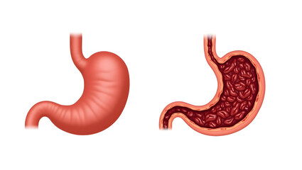 Anatomy&physiology A comparison diagram of healthy and ulcerated stomach, isolated on white, showing mucosal erosion for pathology and gastroenterology (7)