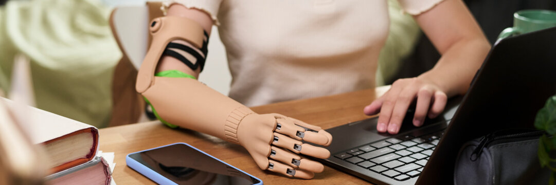 Girl with prosthetic arm studying on laptop at desk