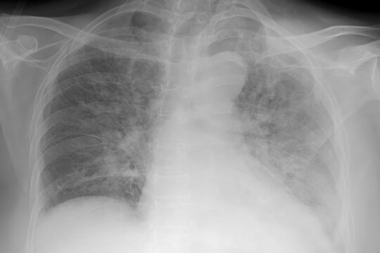 Human lungs with COVID-19 pneumonia, chest X-ray showing bilateral lung infiltrates with interstitial opacities